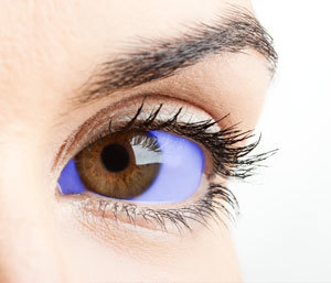Net zoals in deze kunstbewerking kleurt Methyleenblauw het oogwit blauw. Dat is problematisch bij het testen van dit medicijn in verband met placebo effect.  