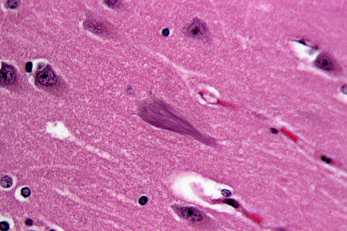 De strepen in het midden van deze afbeelding van de hersenen van iemand met de ziekte van Alzheimer bestaan uit verward tau-eiwit.  Nieuw Alzheimer onderzoek doet vermoeden dat verward tau-eiwit van de ene hersencel op de andere kan worden overgebracht.  