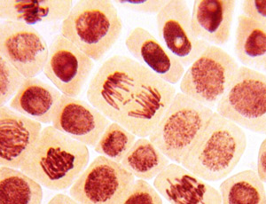 Kanker ontstaat als cellen zich op een ongecontroleerde manier delen. Meer en meer begrijpen we dat dit vaak komt door afwijkingen in ons DNA. Het blijkt nu dat de genetische afwijking die de ZvH veroorzaakt misschien een link heeft met het ontstaan van kanker.