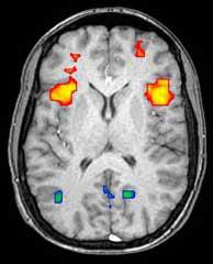 Een voorbeeld van hoe een fMRI scan eruit ziet - hersengebieden die actief zijn op een gegeven moment (in rood) ten opzichte van de minder actieve (in blauw) Deze weergave helpt wetenschappers het actieve brein in kaart te brengen.