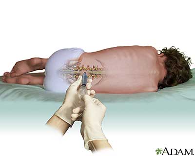 Het ASO medicijn werd geïnjecteerd in het hersenvocht van ALS-patiënten in een proces dat vergelijkbaar is met een lumbaalpunctie of ruggenprik. Niet echt een eitje, maar een stuk eenvoudiger dan een hersenoperatie, welke noodzakelijk is bij de andere 'smaken' van gen-uitschakeling.