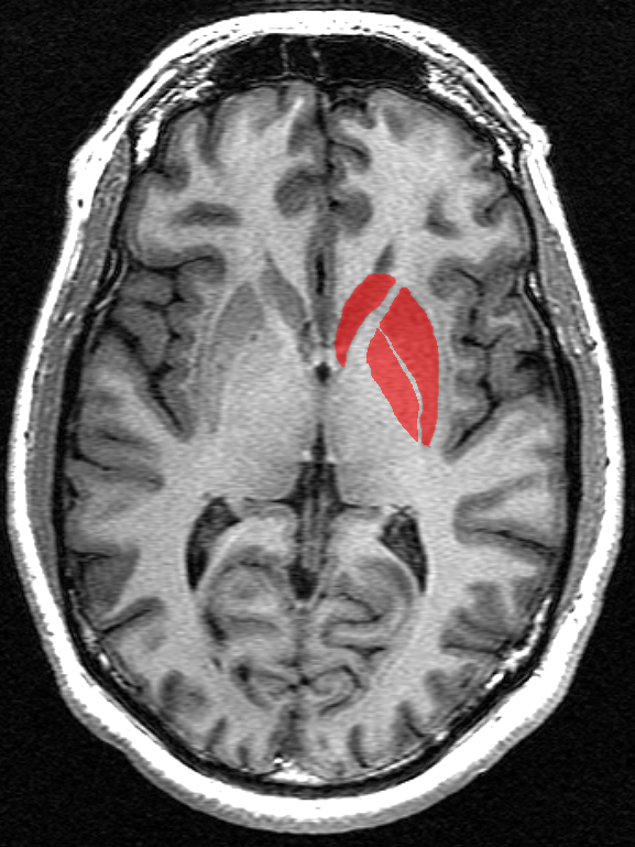 De basale ganglia (in rood) bestaat uit een aantal structuren diep onder het oppervlak van de hersenen. Van deze hersengebieden is al lang bekend dat zij de meeste schade oplopen tijdens de voortgang van de ZvH.