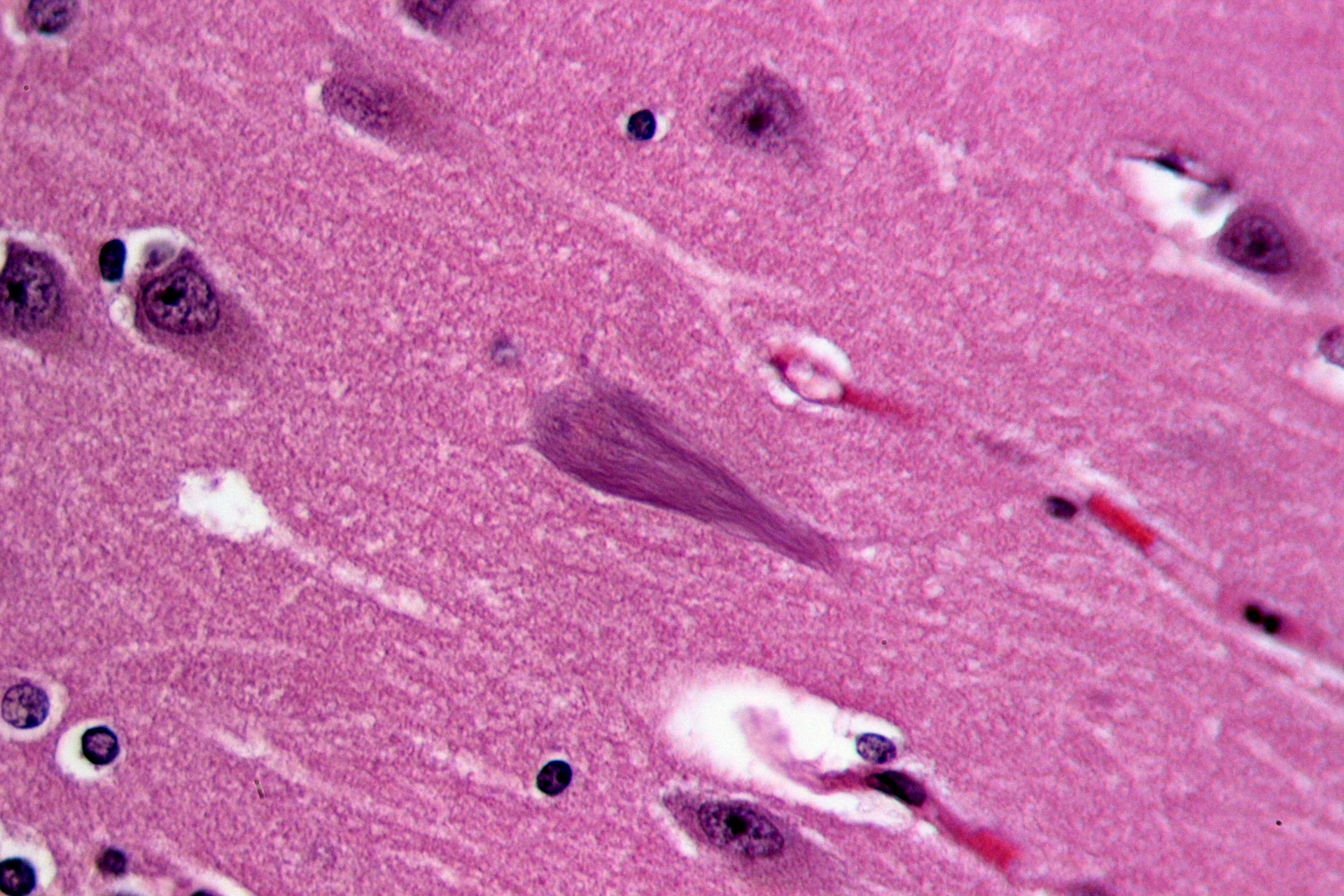 De strepen in het midden van deze afbeelding van de hersenen van iemand met de ziekte van Alzheimer bestaan uit verward tau-eiwit. Nieuw Alzheimer onderzoek doet vermoeden dat verward tau-eiwit van de ene hersencel op de andere kan worden overgebracht.