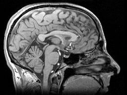 Huntingtine-eiwitmoleculen met te veel glutamine aminozuren gedragen zich niet normaal en kunnen eiwitklonten vormen die zich met verloop van tijd opbouwen in de hersenen van patiënten. Maar deze klonten zijn niet zichtbaar in de meeste soorten hersenscans zoals bijvoorbeeld MRI-scans.  