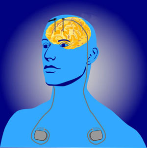 Bij diepe hersenstimulatie worden dunne elektroden door de schedel in de hersenen geplaatst. Generatoren onder de huid leveren elektrische prikkels aan de hersenen.  