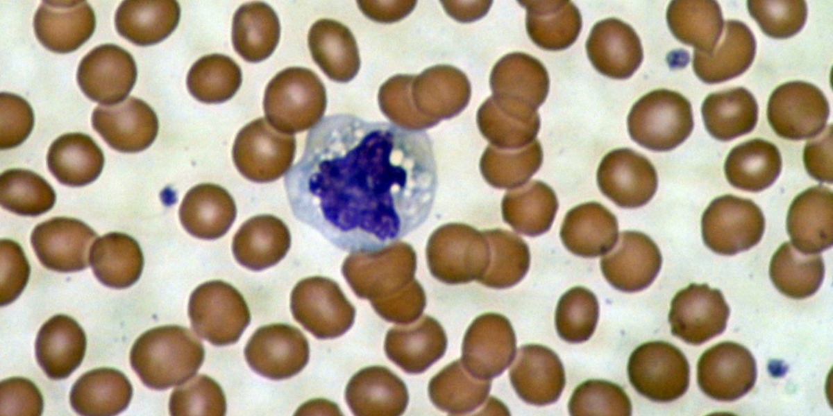 "Oplichtende"  bevindingen in bloedcellen van ziekte van Huntington patiënten