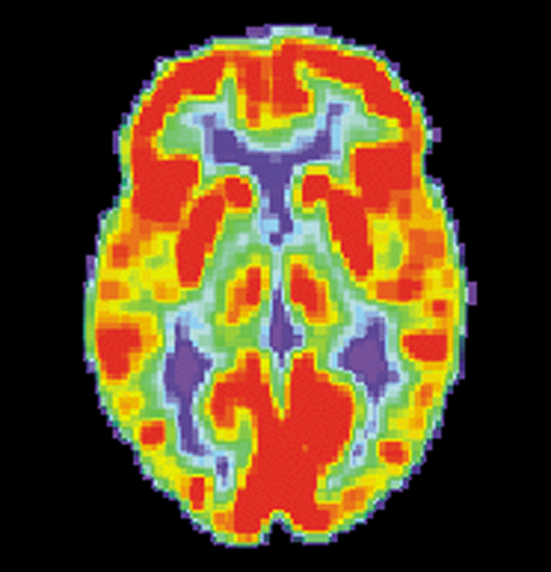 FDG-PET scans stellen ons in staat het suikergebruik van elk hersendeel te zien. Dit is een scan van gezonde hersenen. Rode cellen verbruiken het meeste suiker.  