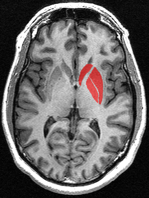 De basale ganglia (in rood) bestaat uit een aantal structuren diep onder het oppervlak van de hersenen.  Van deze hersengebieden is al lang bekend dat zij de meeste schade oplopen tijdens de voortgang van de ZvH.  