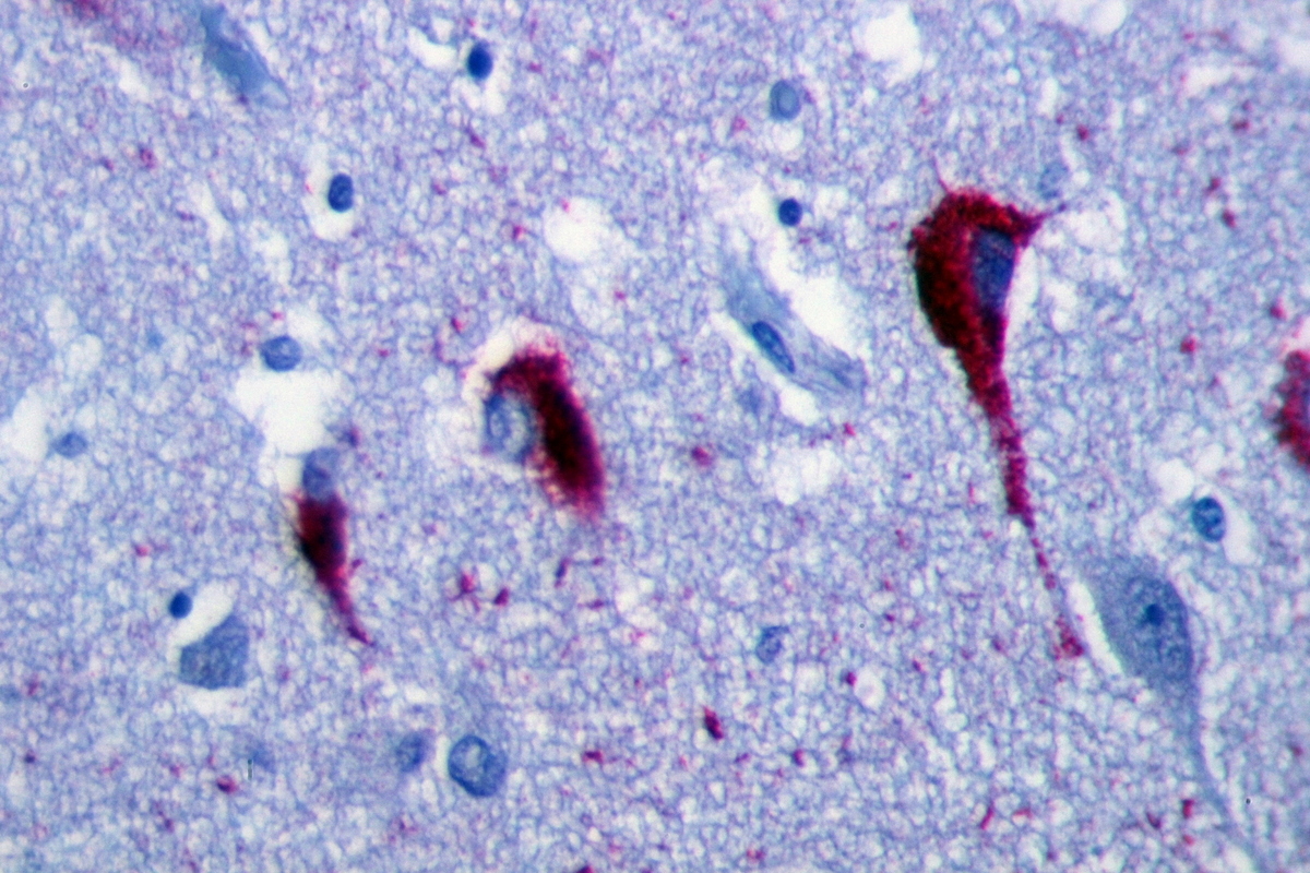 Dit is hoe het tau eiwit er uitziet als het samenklontert in ‘neurofibrillaire bundels’ in de hersenen van een Alzheimer patiënt. Tau is vernoemd naar de Griekse letter ‘T’.  