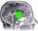 Mollige muizen wijzen op het belang van de hypothalamus bij de ziekte van Huntington