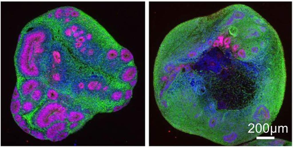 Recente ontwikkelingen hebben wetenschappers in staat gesteld om neuronen in 3D te laten groeien en zo een minibrein te modelleren.  In deze studie bleken juveniele ZvH-minibreinen (rechts) minder en kleinere interne structuren te hebben, hier in roze weergegeven, in vergelijking met organoïden van iemand zonder de ZvH (links).  