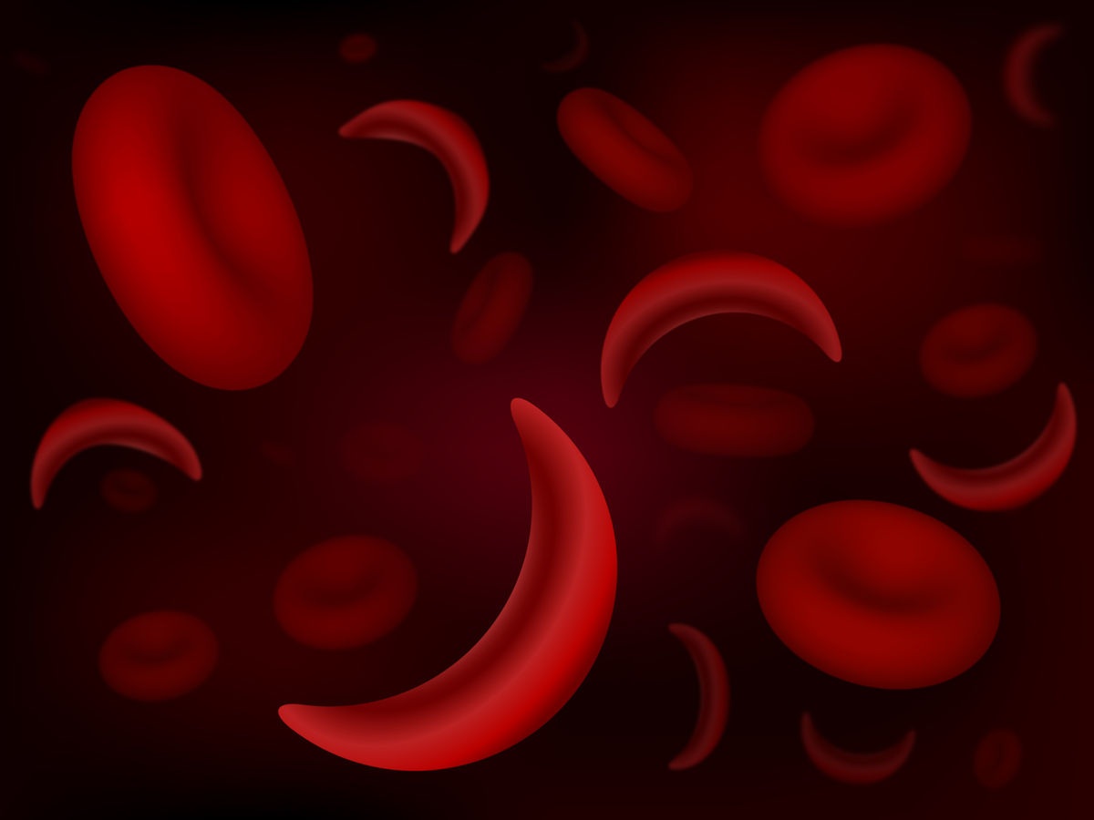 Sikkelcelziekte veroorzaakt dat rode bloedcellen een 'C' of sikkelachtige vorm aannemen. Mensen met deze ziekte missen een eiwit dat rode bloedcellen een rigide vorm geeft waardoor zuurstof door het hele lichaam getransporteerd kan worden. Omdat bij mensen met sikkelcelziekte minder zuurstof vervoerd wordt, hebben zij minder rode bloedcellen, kunnen bloedvaten verstopt raken en kan dit mogelijk leiden tot een beroerte.  